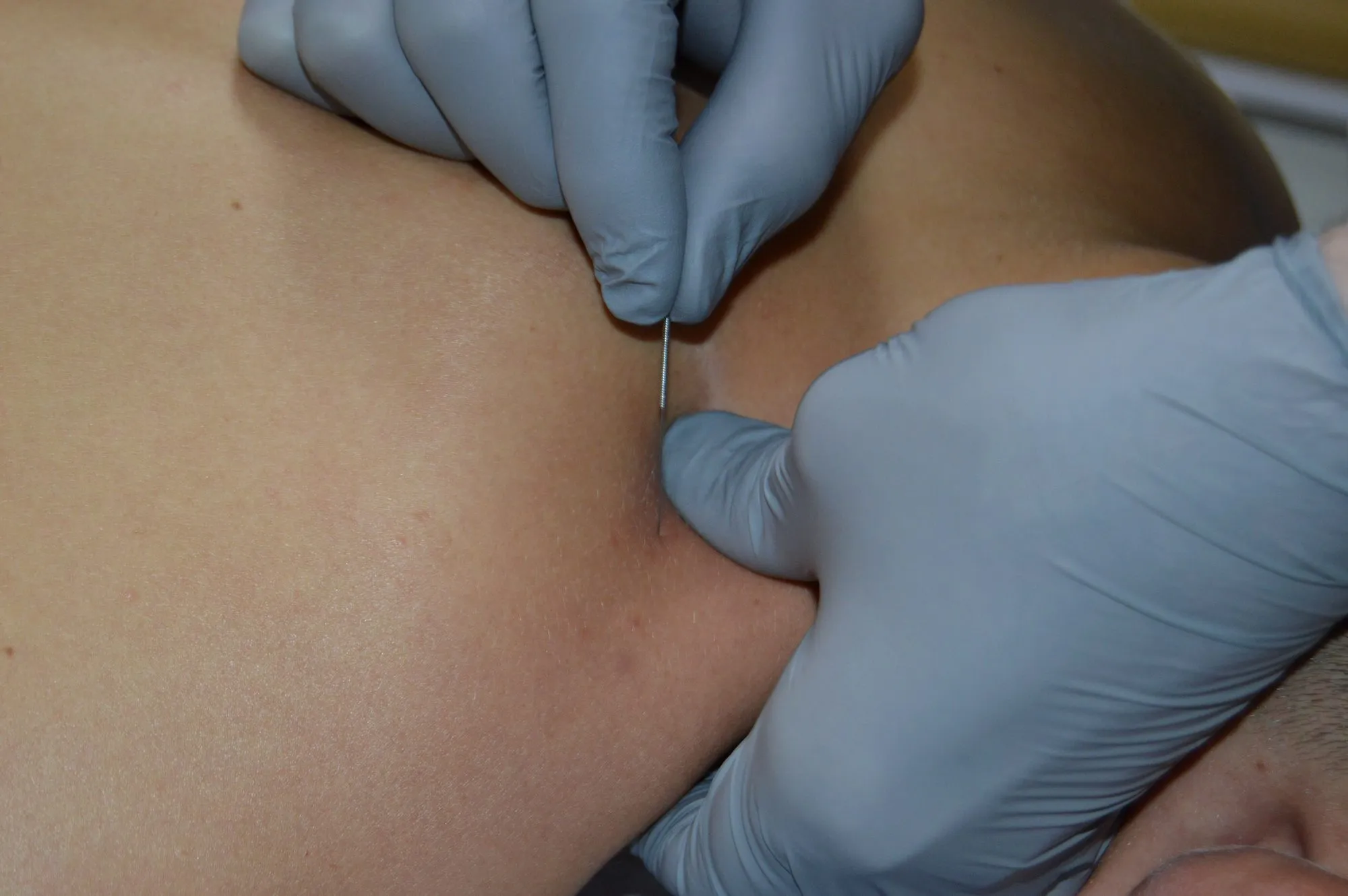 Plan apropiat cu acul steril de dry needling introdus între degetele înmănușate, în punctul trigger localizat.